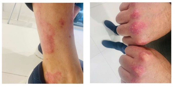Asociación entre la Psoriasis y la Microbiota intestinal