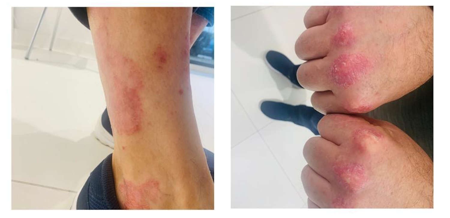 Asociación entre la Psoriasis y la Microbiota intestinal